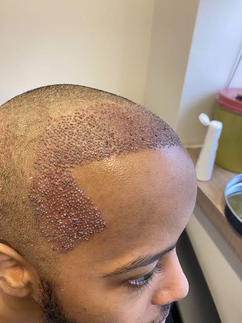 Hair Transplant