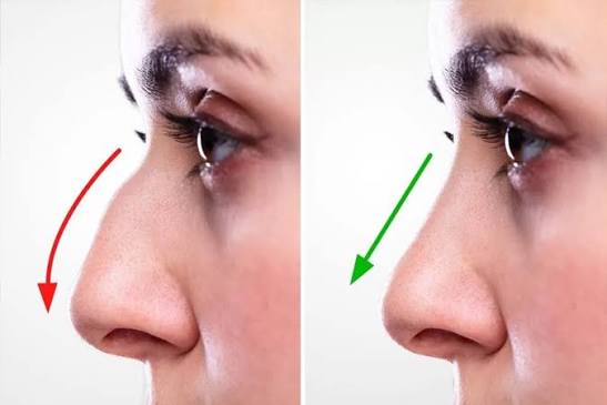 Rhinoplasty