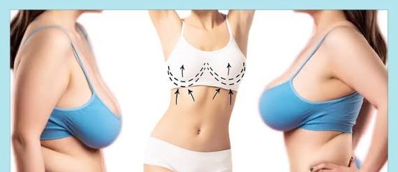 Breast Lift