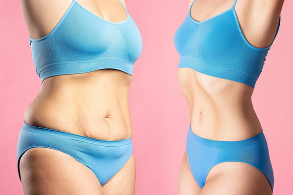 Liposuction