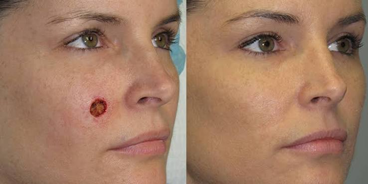 Cancer Reconstruction