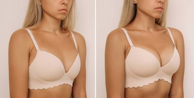 Breast Augmentation