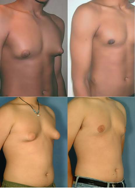 Gynecomastia