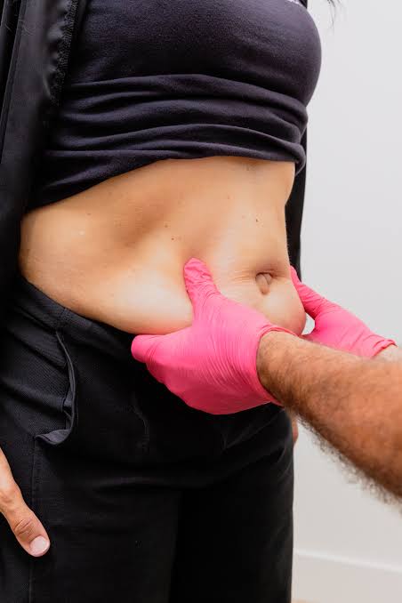 Tummy Tuck