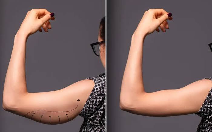 Brachioplasty