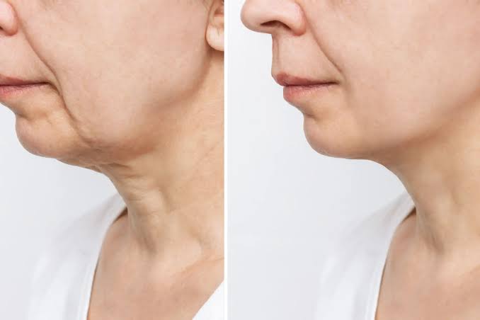 Neck Lift