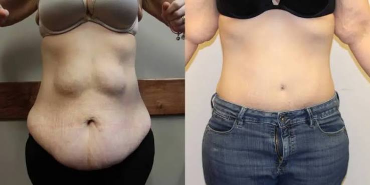 Belt Lipectomy