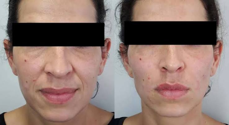 Dermal Fillers