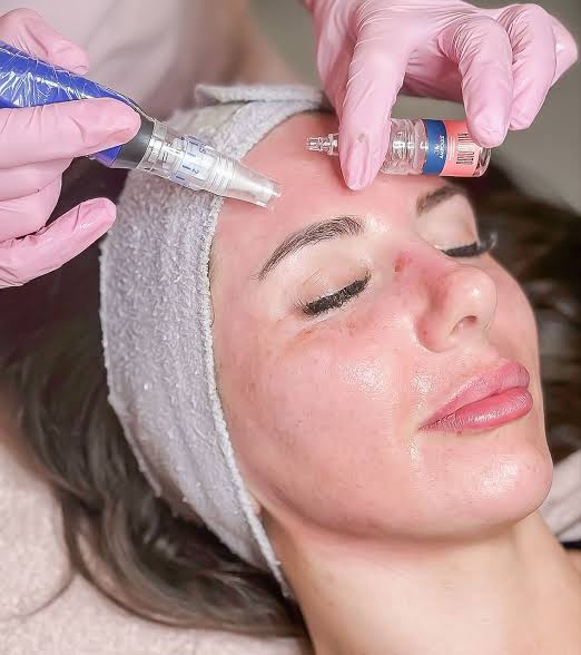 Microneedling