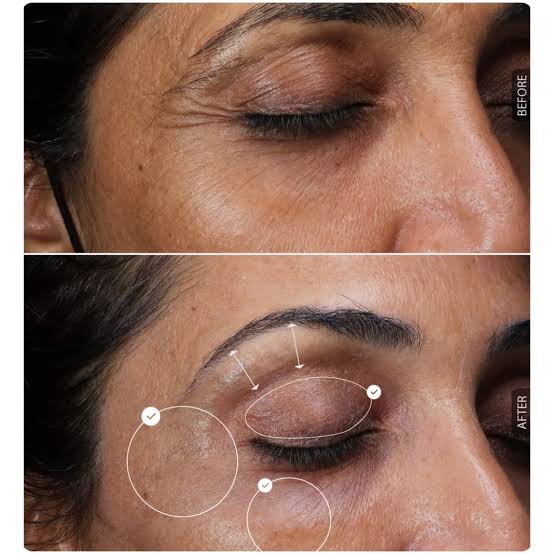 Laser Skin Rejuvenation