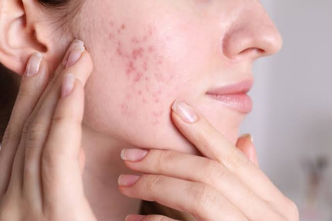 Acne Scar