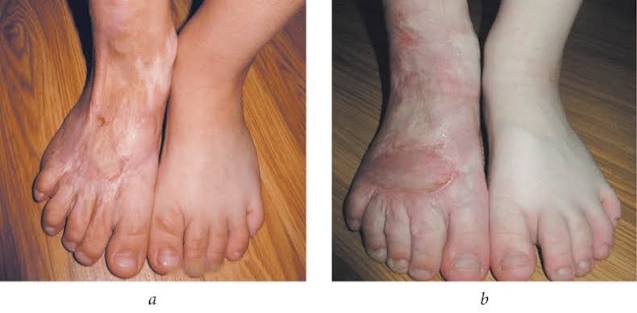 Burn Deformity