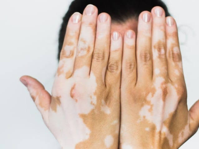 Vitiligo