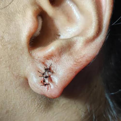 Ear Lobe Repair