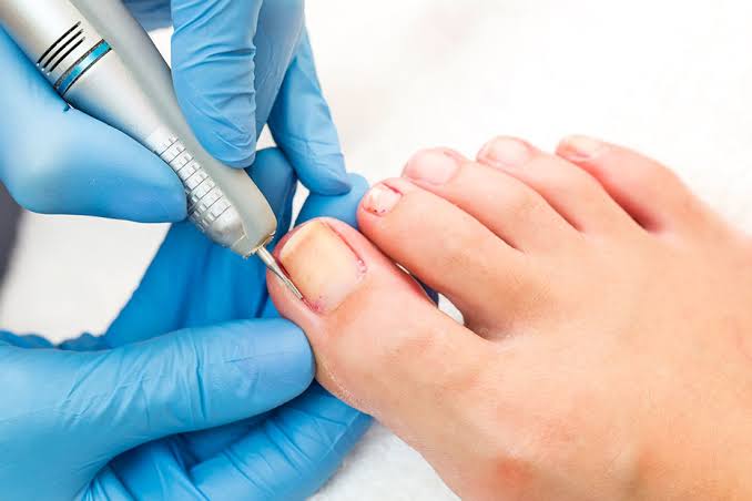 Nail Surgery