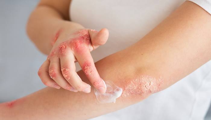 Skin Grafts