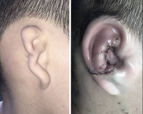 Ear Surgery