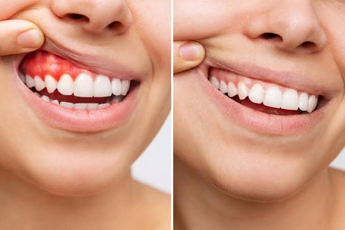 Gummy Smile