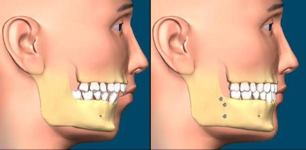 Chin Surgery