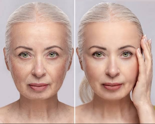 Facelift