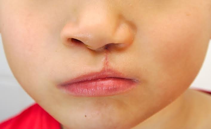 Cleft Lip