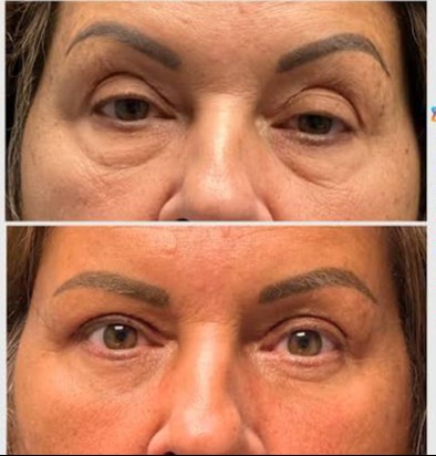 Blepharoplasty